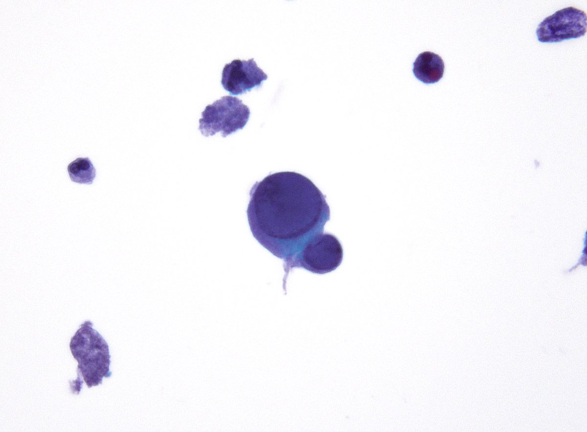 sza_jhcyto's tweet photo. Deceptively atypical-appearing nuclei hiding a viral culprit in plain sight - BK virus infection in exfoliative urinary cytology. (ThinPrep) https://t.co/szuwfLD4ml