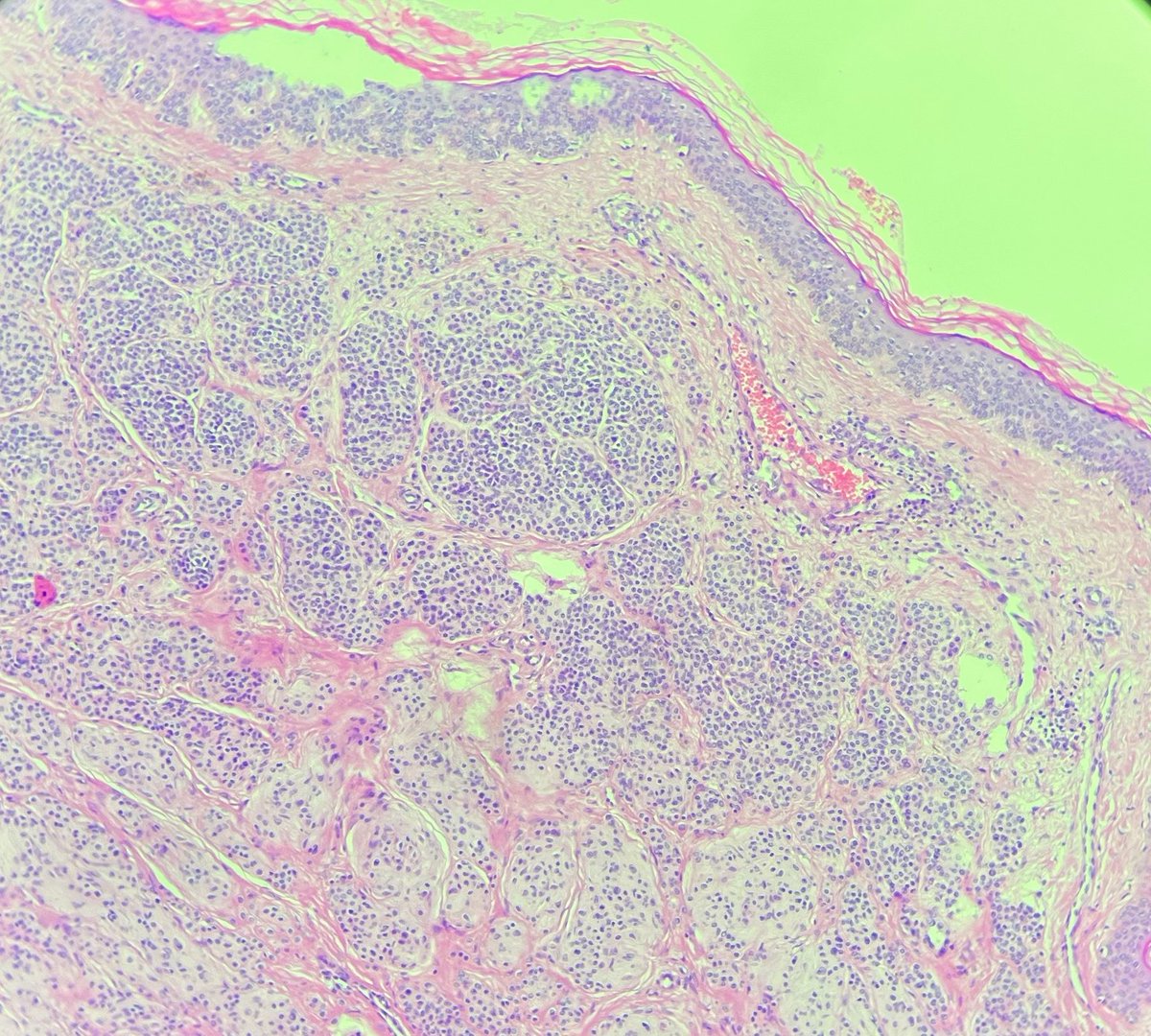 senaadsizdayanc's tweet photo. intradermal melanocytic nevi/ inclusion 
#dermpath #lovepath https://t.co/EAnKUx01Xw