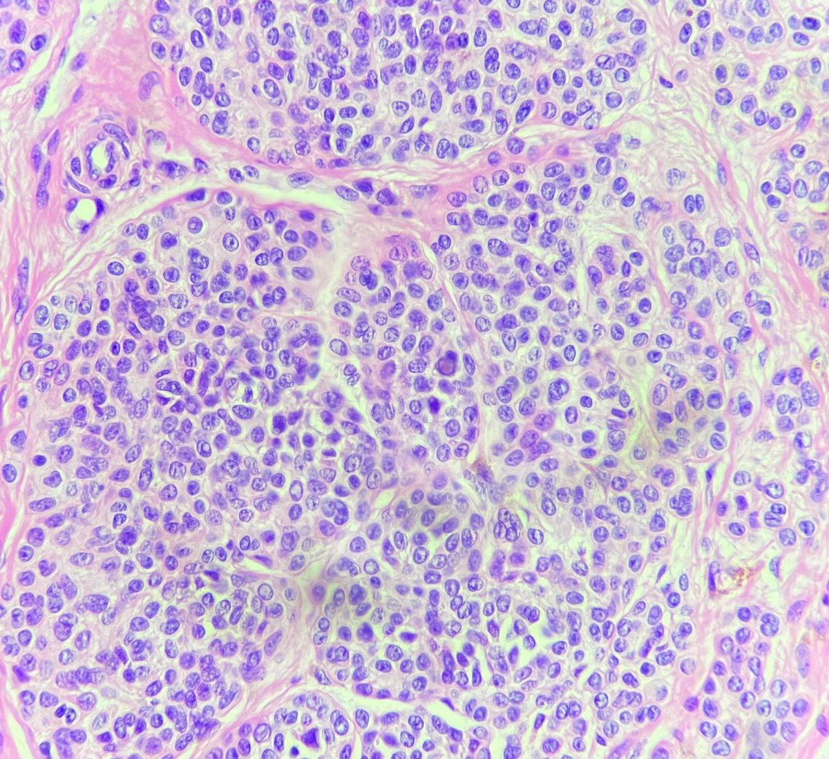 senaadsizdayanc's tweet photo. intradermal melanocytic nevi/ inclusion 
#dermpath #lovepath https://t.co/EAnKUx01Xw