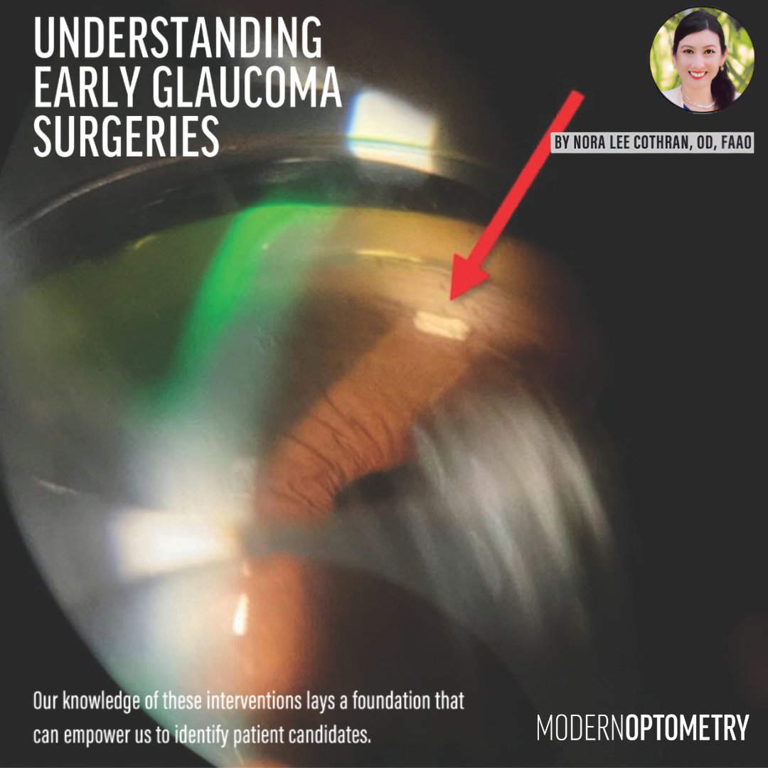 ModOptometry's tweet photo. Earlier glaucoma intervention is redefining patient care. From SLT to MIGS, emerging surgical options are helping reduce treatment burden while improving long-term outcomes and adherence: https://t.co/4iBi8P9faw

#Glaucoma #Optometry #MIGS #EyeCare https://t.co/ehKcxITBlE