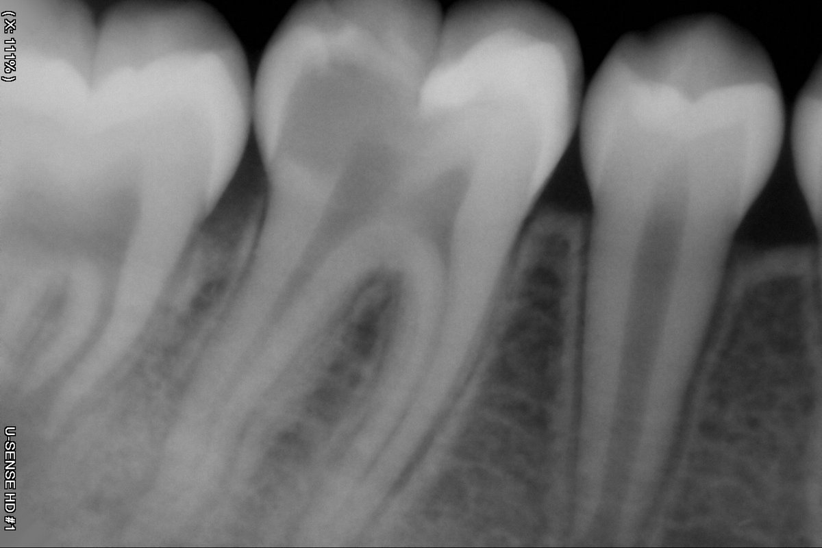 3lim0h's tweet photo. 14 years old female patient , referred from student.
Diagnosis was SIP /SAP .
3 canals was located , 
Preparation was done by Race Evo files .04 
Irrigation by NaoCl %5 activated by sonic activator 
Sealer : Bioceramic 
Build up was done by Composite.
Anatomy was restored 👌 https://t.co/rtCoaAAHIh