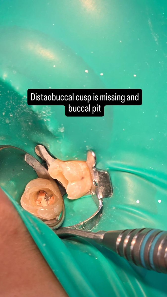 3lim0h's tweet photo. 14 years old female patient , referred from student.
Diagnosis was SIP /SAP .
3 canals was located , 
Preparation was done by Race Evo files .04 
Irrigation by NaoCl %5 activated by sonic activator 
Sealer : Bioceramic 
Build up was done by Composite.
Anatomy was restored 👌 https://t.co/rtCoaAAHIh