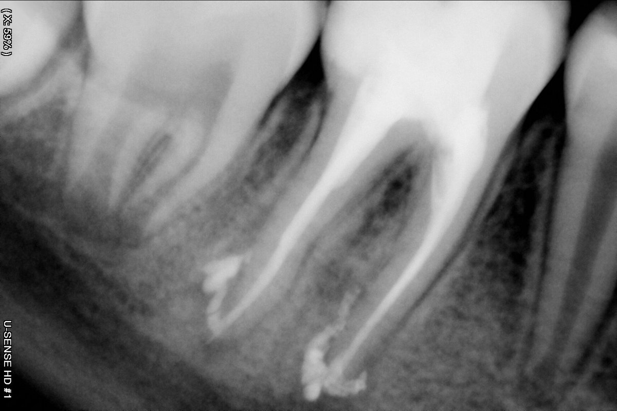 3lim0h's tweet photo. 14 years old female patient , referred from student.
Diagnosis was SIP /SAP .
3 canals was located , 
Preparation was done by Race Evo files .04 
Irrigation by NaoCl %5 activated by sonic activator 
Sealer : Bioceramic 
Build up was done by Composite.
Anatomy was restored 👌 https://t.co/rtCoaAAHIh