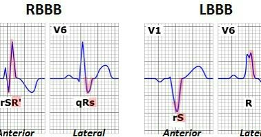 TrackYourHeart's tweet photo. What effects do LBBB, RBBB and LVH with repolarization abnormalities have on exercise stress testing interpretation?

🔴 LBBB → ST changes are unreliable due to abnormal repolarization. False-positive ST depressions may appear in V5-V6, I, aVL. Instead, use nuclear stress imaging or stress echo for accurate assessment.

🔵 RBBB → Less impact than LBBB, but ST-T changes in V1-V3 are not ischemic. Focus on inferolateral leads (V5-V6, II, III, aVF, I, aVL) for valid ischemia detection.

🟢 LVH with repolarization abnormalities → ST depressions & T-wave inversions (strain pattern) are common, especially in lateral leads (I, aVL, V5-V6). These changes often lead to false positives, making imaging crucial for confirmation.