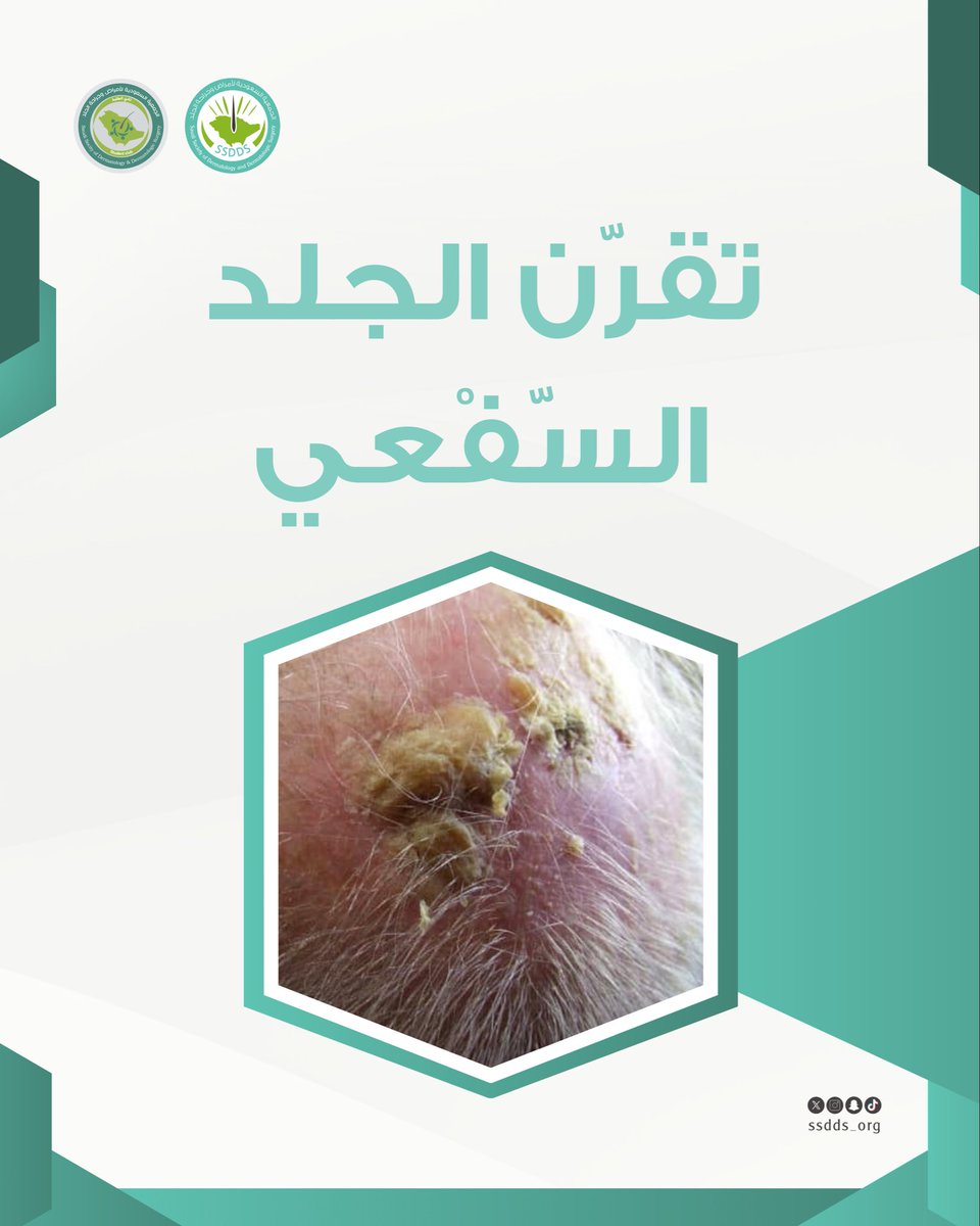 Saudi Society of Dermatology & Derm Surgery(SSDDS) tweet media