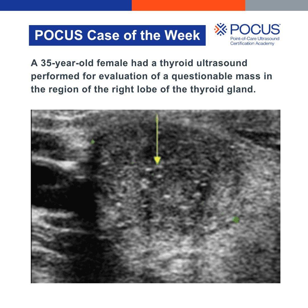 POCUSAcademy's tweet photo. π£ Case of the week!
Let us know your answer in the comments!
#POCUS #POCUSCaseStudyChallenge https://t.co/rCHCInytlm