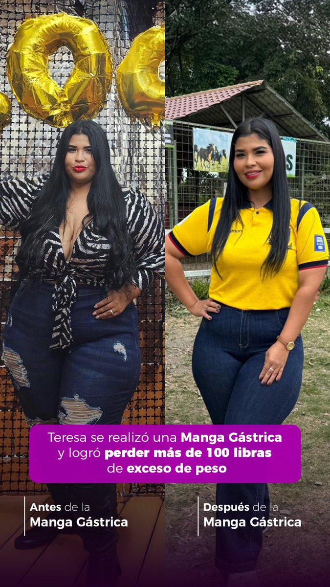 droliverjoel's tweet photo. La cirugía bariátrica es el tratamiento más eficaz para la obesidad severa y se recomienda cuando otros métodos, como la dieta y el ejercicio, no han tenido resultados duraderos. #perderpeso #cirugiabariatrica https://t.co/ScCEKGFCNl
