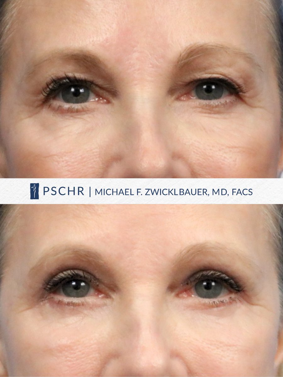 DrZPSCHR's tweet photo. No more heavy lids or under-eye bags. ✨
ㅤ
At 3 months post-op, this 61-year-old patient is enjoying smoother upper lids and a more refreshed under-eye area after her Upper + Lower #Blepharoplasty with Dr. Z.
ㅤ
🌐 | https://t.co/QC9Xi0xFSv

#EyelidSurgery #PlasticSurgery https://t.co/QwB3iCvpUn