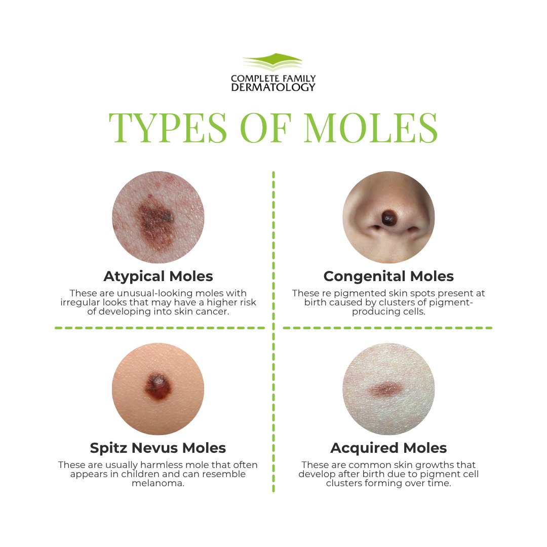 CompleteFamily7's tweet photo. Did you know… there are some types of moles that can increase a person’s risk of developing melanoma, the most serious form of skin cancer?

At CFD, we are specialized in skin cancer treatment and detecting potential problems before they become serious–402-423-1111 📞 https://t.co/6mpErN6Cpd