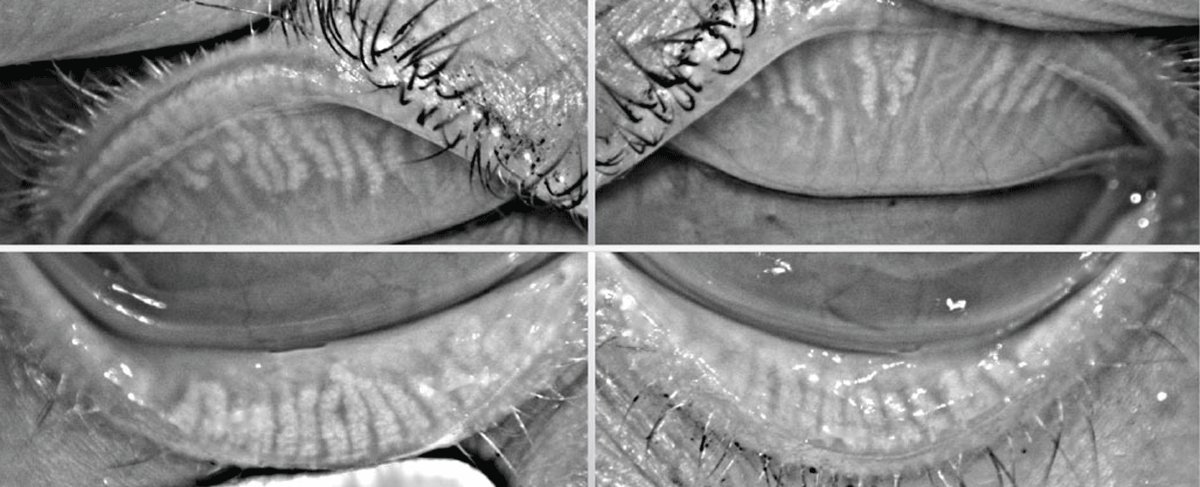 revoptom's tweet photo. A Practical Guide to Lid-Centric Diagnosis and Management​

Reframing the ocular surface exam for more accurate, efficient and targeted care.
https://t.co/eN4neeRTVe

#dryeye #dryeyedisease #MGD #eyecare #optometry https://t.co/LYr8uAi6YG