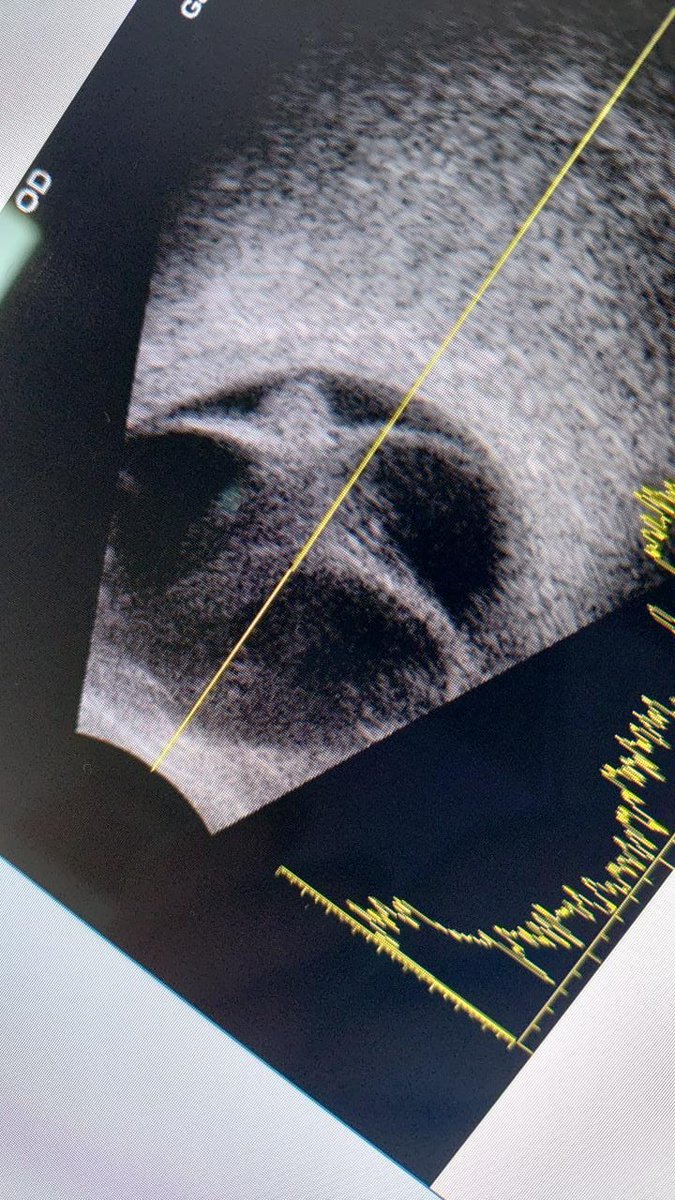 facovitrecto's tweet photo. Este ultrasonido de un desprendimiento de retina me hizo el día https://t.co/iNHBMeCrkI