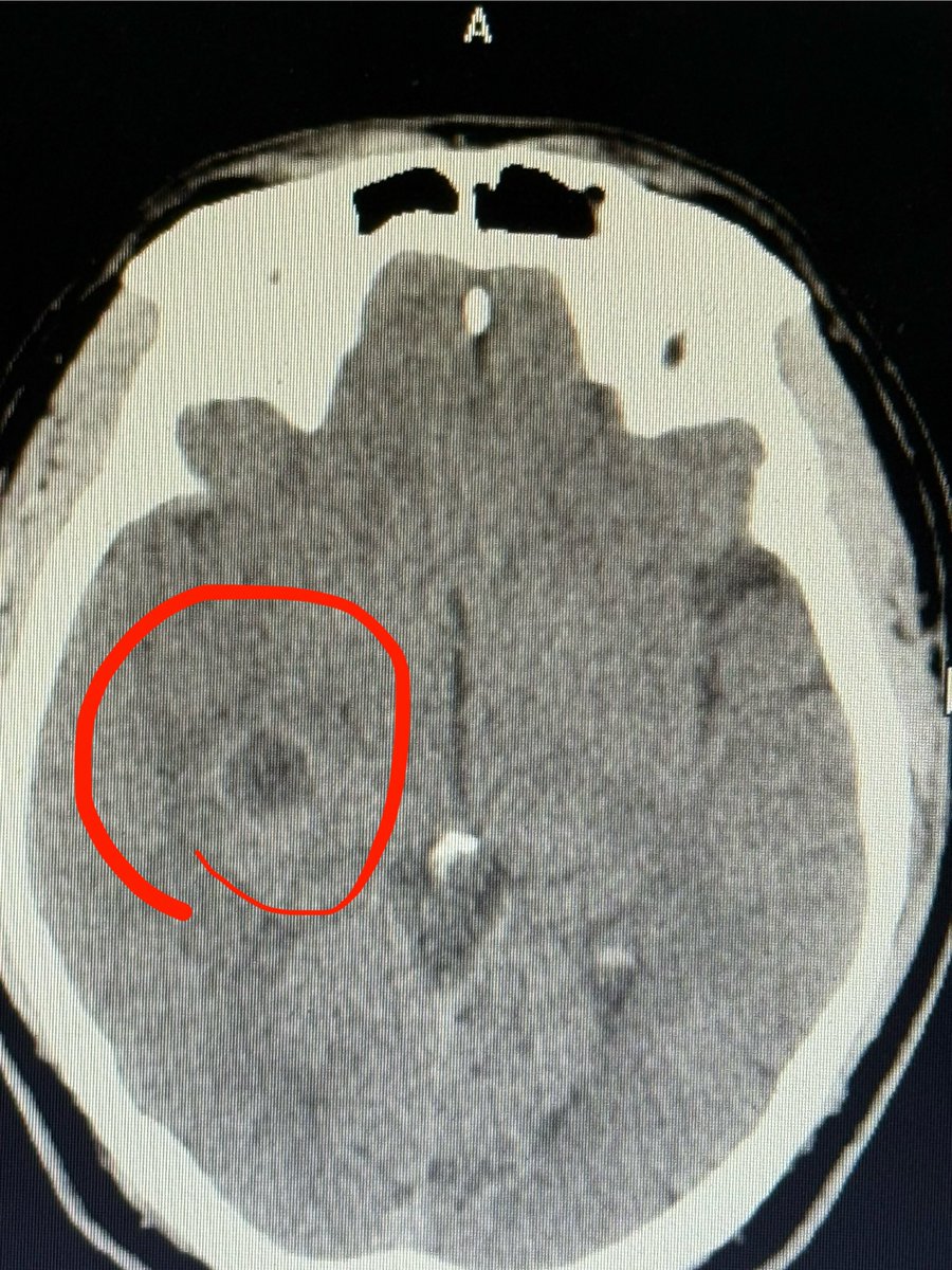 GrtSeizuresGhst's tweet photo. @Lanica333 @ValerieAnne1970 @naomirwolf @IanCopeland5 @sjs856 Brain tumor in covid vaxd brain https://t.co/8HLW01Hpe3