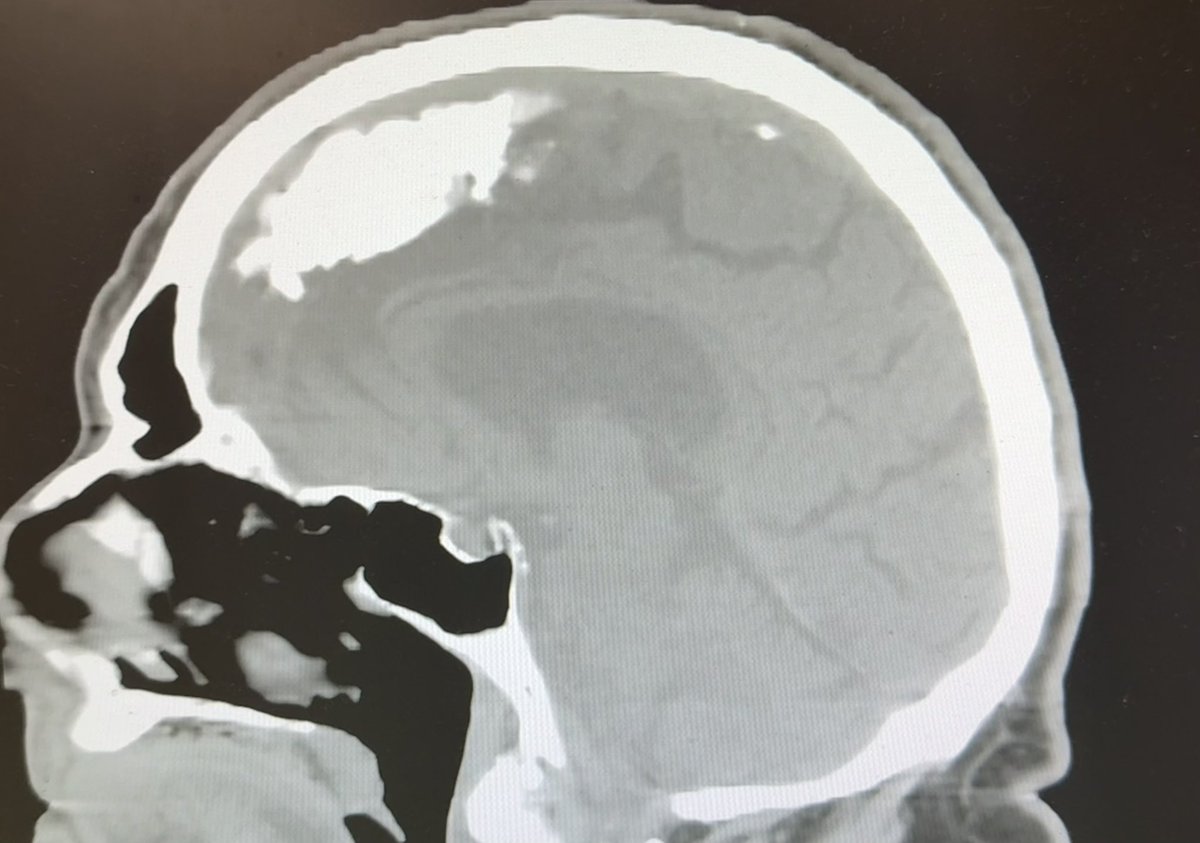 GrtSeizuresGhst's tweet photo. @Lanica333 @ValerieAnne1970 @naomirwolf @IanCopeland5 @sjs856 The WHITE areas in these brain scans= brain damage in the covie vaxd brain https://t.co/MpwELViqWG