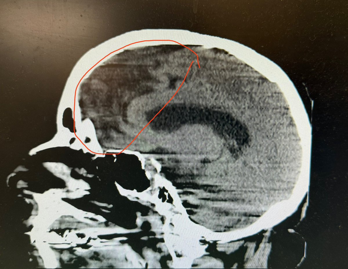 GrtSeizuresGhst's tweet photo. @Lanica333 @ValerieAnne1970 @naomirwolf @IanCopeland5 @sjs856 Black frontal lobe after covid vax= RETARD SHOTS bc pt is now retarded https://t.co/Rvs19hBIDC