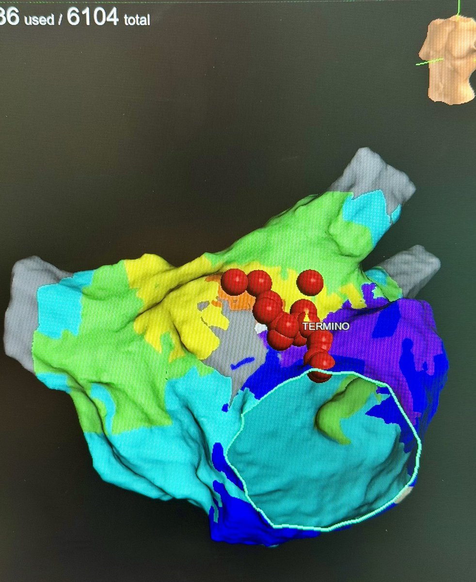 IsaParam's tweet photo. HD Grid X. Focal RF ablation interrupted AFL https://t.co/0RQ2uYBz0a