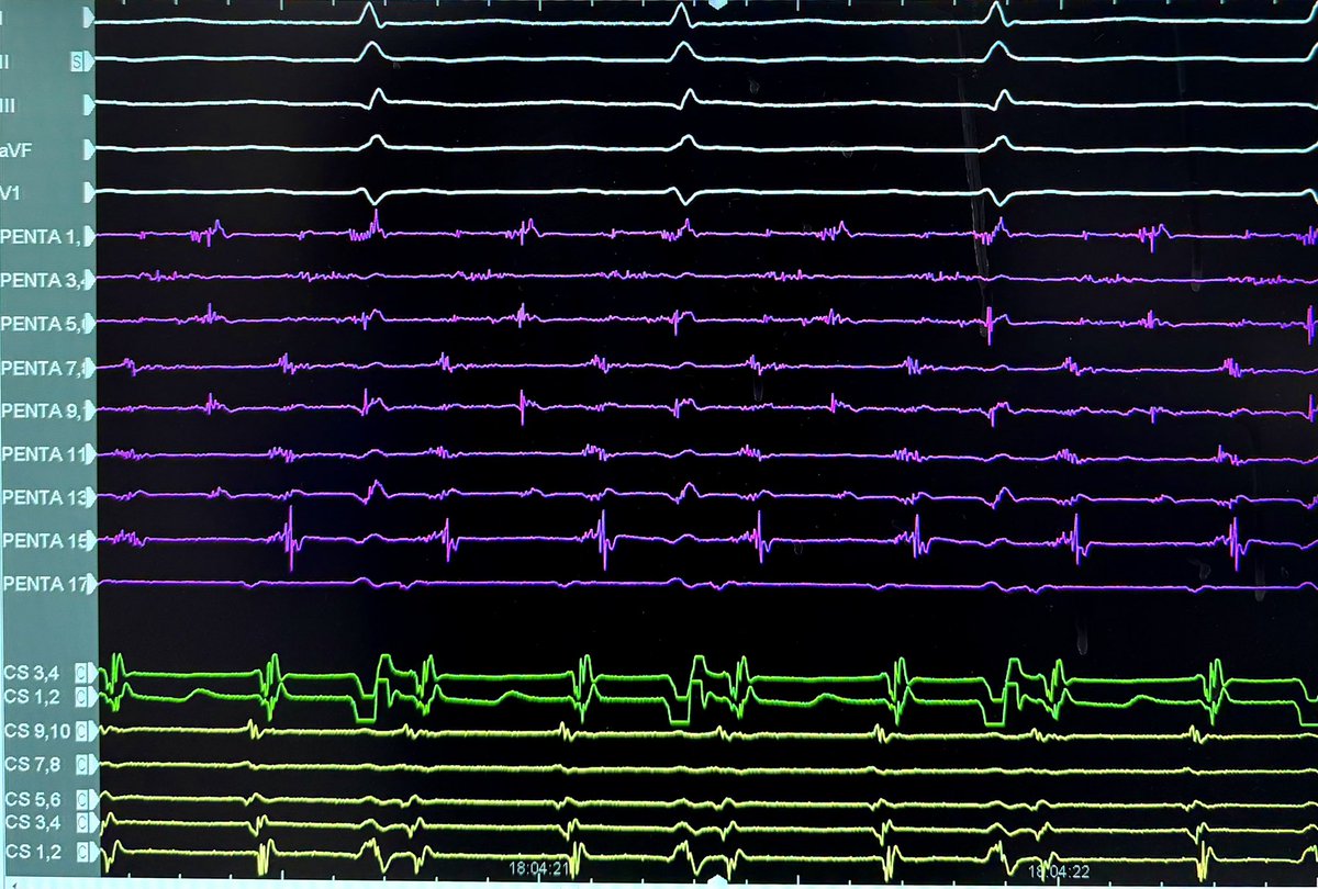 IsaParam's tweet photo. HD Grid X. Focal RF ablation interrupted AFL https://t.co/0RQ2uYBz0a