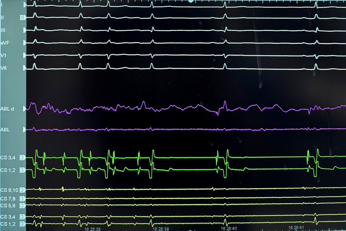 IsaParam's tweet photo. HD Grid X. Focal RF ablation interrupted AFL https://t.co/0RQ2uYBz0a