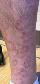 schowardjd's tweet photo. Eruptive pruritic papular porokeratosis is an inflammatory variant of porokeratosis characterized by intensely pruritic annular papules & plaques w/ peripheral scale corresponding histologically to cornoid lamellae.  

An elderly man presented w/ a 5-year hx of severely pruritic annular & round erythematous plaques involving the scalp, trunk, & extremities. Many lesions demonstrated peripheral scale w/ central clearing, while others showed confluent scale & hemorrhagic crusting from excoriation, resulting in significant sleep disturbance & impaired QoL. He attributed disease onset to a prior COVID-19 vaccination & had a personal hx of eczematous dermatitis w/out a FHx of atopy.  

Biopsies demonstrated cornoid lamellae w/ a superficial perivascular & focally lichenoid lymphohistiocytic infiltrate, supporting eruptive pruritic papular porokeratosis.   

The differential diagnosis included disseminated superficial actinic porokeratosis (DSAP), nummular dermatitis, psoriasis, tinea corporis, pityriasis rubra pilaris, annular lichen planus, and cutaneous T-cell lymphoma.  

The patient failed topical cholesterol-lovastatin & dupilumab (Dupixent®️) but experienced rapid improvement in pruritus & lesional inflammation w/ upadacitinib (RINVOQ®️), supporting an inflammatory JAK1-mediated component in this porokeratosis variant. 

Torso, back, & right distal lower extremity after 4 weeks of upadacitinib treatment, demonstrating a significant reduction in both erythema & lesion thickness.👇🏻👇🏻👇🏻