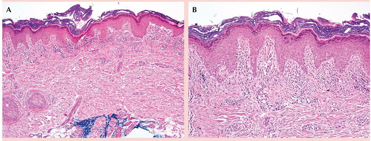 gederm's tweet photo. Histopatología 🔬  
• Hiperqueratosis  
• Acantosis en “dientes de sierra”  
• Vacuolización de capa basal  
• Cuerpos de Civatte  
• Infiltrado linfocitario en banda https://t.co/npCkLtGmHq