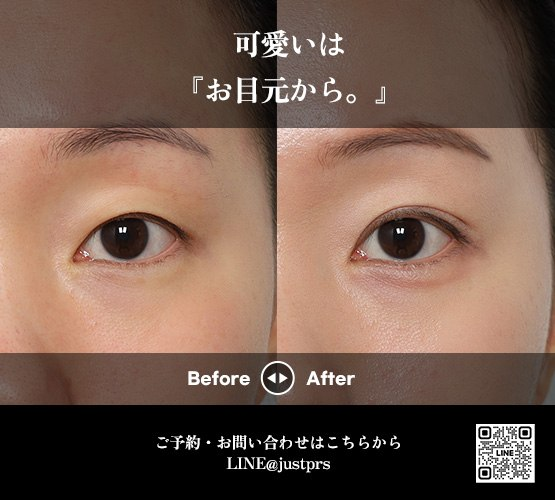 【韓国】糸リフト・目の下脂肪再配置・目整形専門ジャスト美容整形外科 tweet media