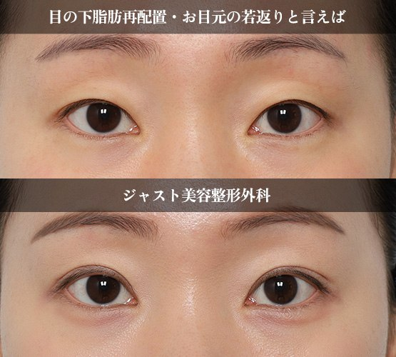 【韓国】糸リフト・目の下脂肪再配置・目整形専門ジャスト美容整形外科 tweet media