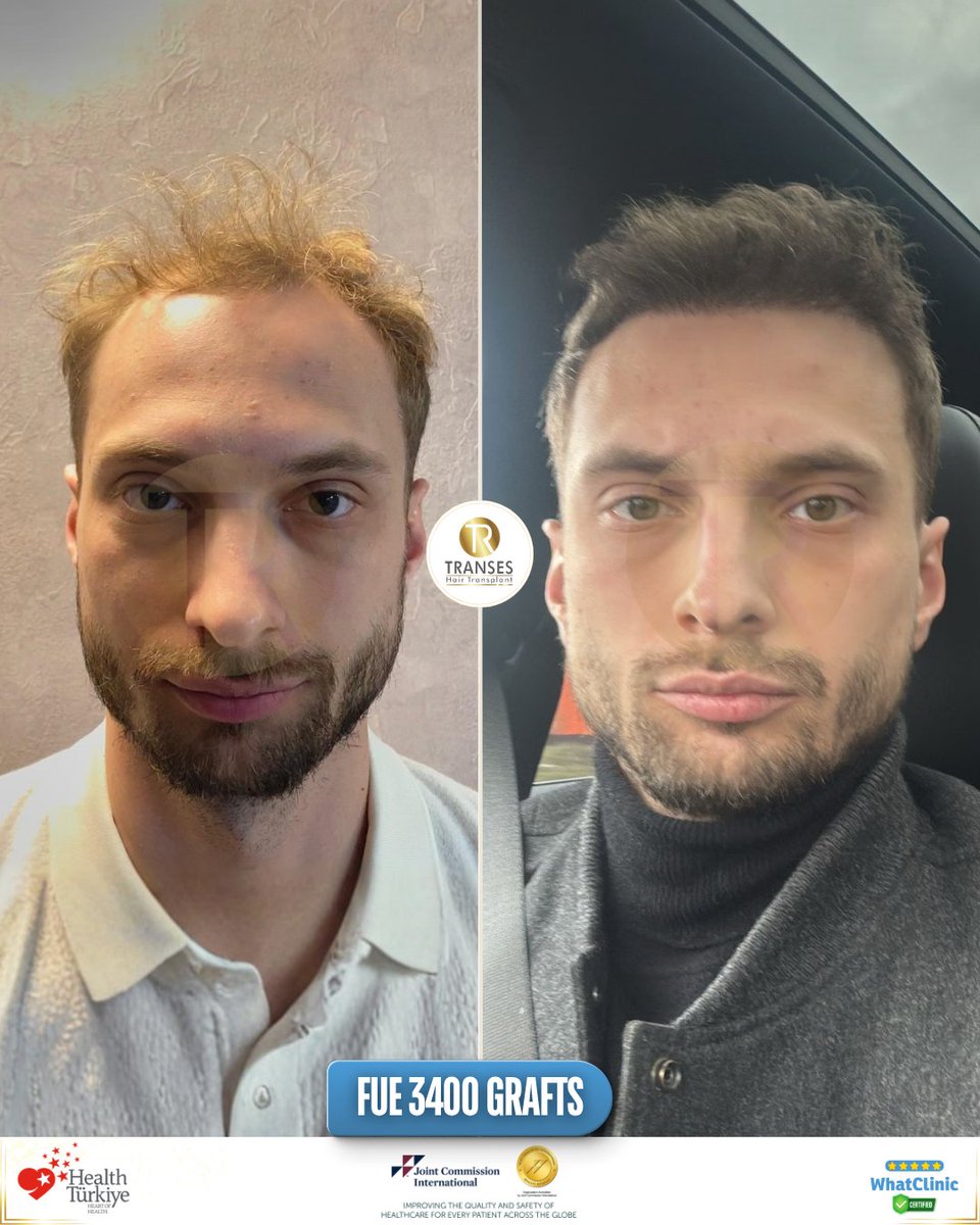 transeshair's tweet photo. This hair transplant operation was performed at Istanbul Tema Hospital BHT Clinic.
15 years of experience with a 4.9 ⭐ WhatClinic rating.
FUE • DHI • HYBRID • PRP
Natural results, professional care.

#YourJourneyYourTransformation
#TransesHairTransplant
#FUE #DHI #PRP https://t.co/adCq6Pt9Qz