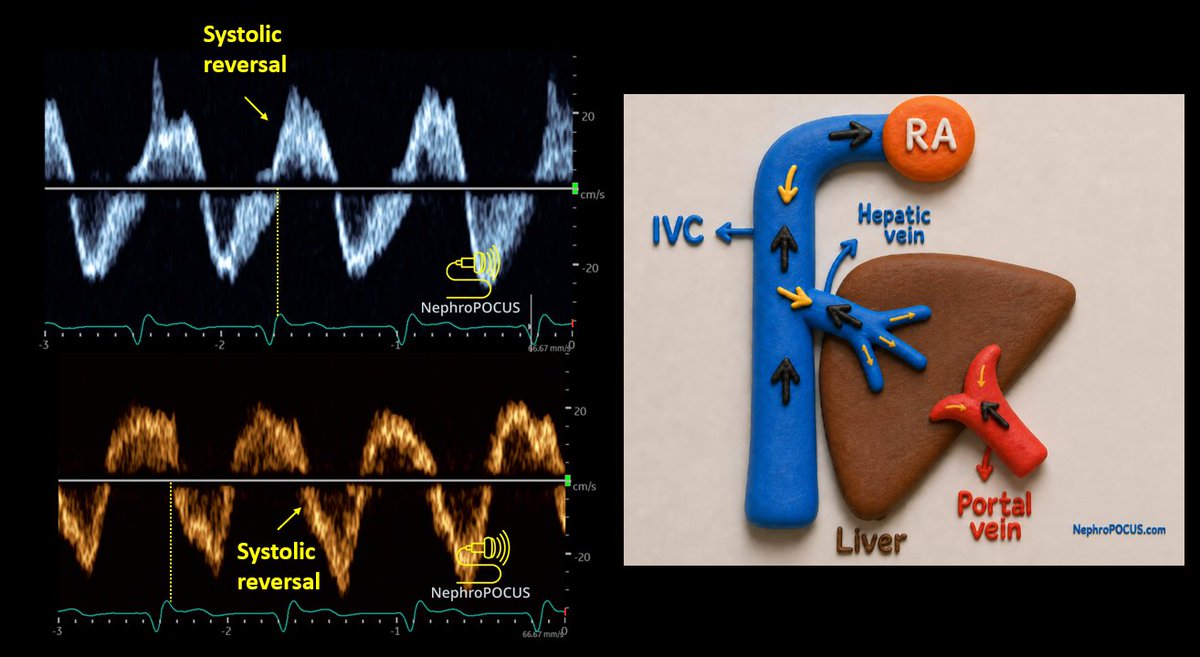 RT @NephroP: #POCUS #VExUS answer: A = hepatic vein Doppler, B = portal ...