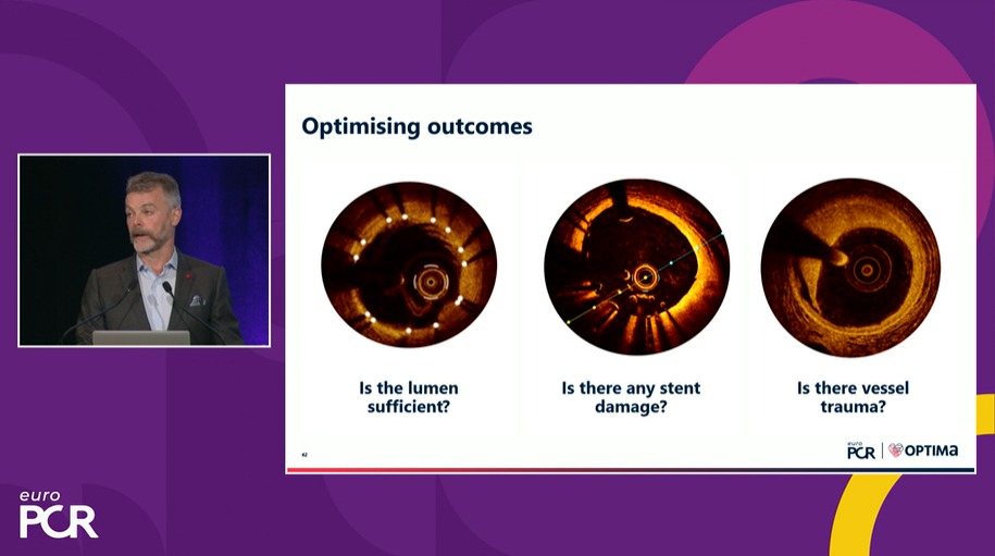 Zill_cardio's tweet photo. How does
 
IVI guidance 

helps in 

the treatment of 

calcified lesions ⁉️

#IVimaging #CaC #EuroPCR
@PCRonline https://t.co/XXfwOXMYk4