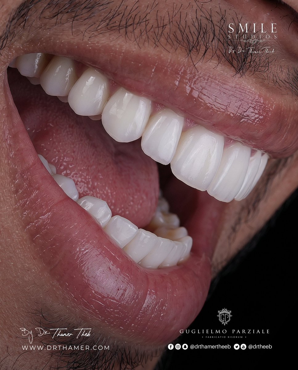 drtheeb's tweet photo. A flawless smile begins with precision

#smilestudios #cosmeticdentistry #smiledesign #dentalaesthetics #دثامرذيب https://t.co/2QQcicjnpm