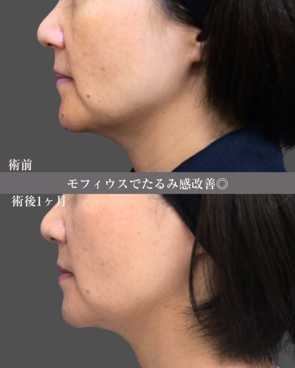 theclinic_kuro's tweet photo. モフィウス 施術モニター募集✨
【内容】
・モフィウス　(目の下、法令線、口横、フェイスライン)
・2名様：施術費用全額免除

【応募方法】
1.このアカウントをフォロー
2.この投稿をリポスト&いいね
→ 後日DMで詳細＆カウンセリング予約をお送りします

【応募条件】
・施術前後写真および経過レポートのHP/SNS掲載にご協力いただける方（顔出しは相談可能です）
・18歳以上

※効果には個人差があります。
カウンセリングで適応外の場合はご案内できない場合があります。

主なリスク：腫れ・内出血・色素沈着など
（詳細はカウンセリング時に説明いたします）

締切：5月30日 (土) 正午