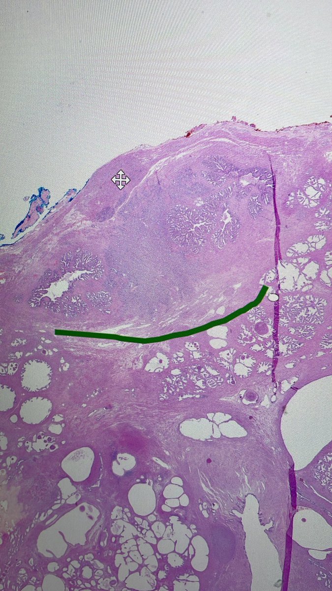saharimranhamid's tweet photo. Hi
Will u call it 3b  extending Ito seminal vesicle in continuity from intraprostatic part https://t.co/j4vmMaoDXJ
