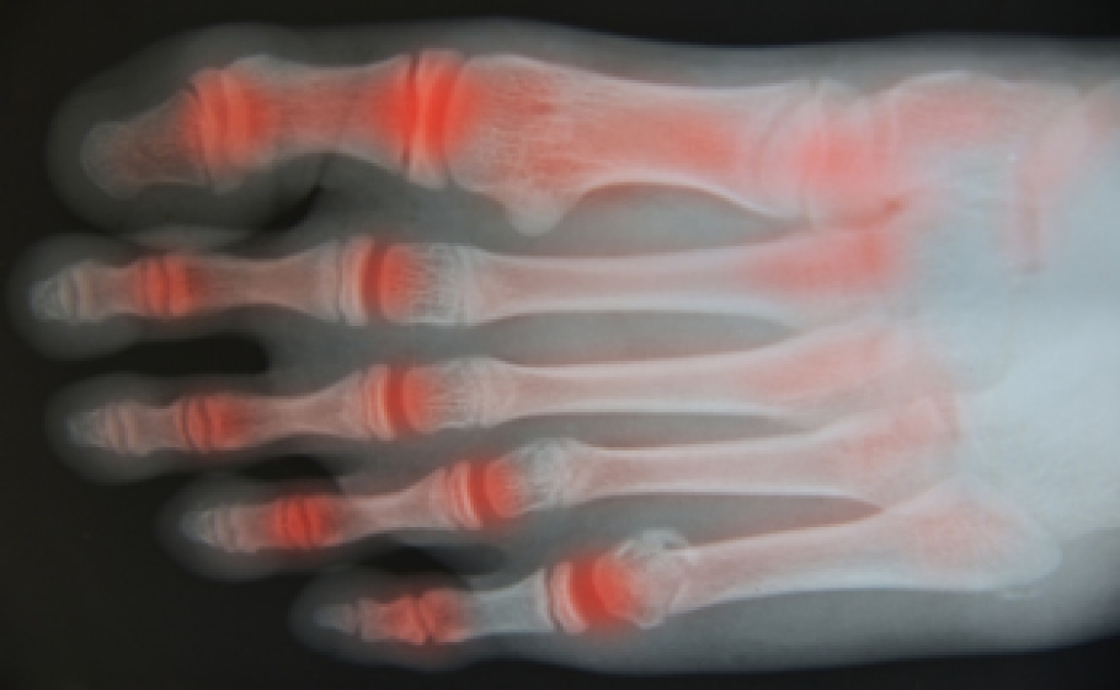 FootCareInst's tweet photo. Osteoarthritis and Its Impact on Foot Health https://t.co/YxTdstQ7qY https://t.co/V37bQvFLR2