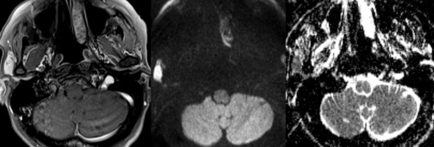 daniel_gewolb's tweet photo. βοΈ What is the most likely diagnosis in this 70 y/o F presenting for follow up cystic parotid lesions with history of Sjogren disease?
π·Second image was acquired 1 year later and the finding is new
#radres #radiology #futureradres #Medicine #ENT #neurology #neurosurgery #FOAMed #MRI @ASHNRSociety @TheASNR
