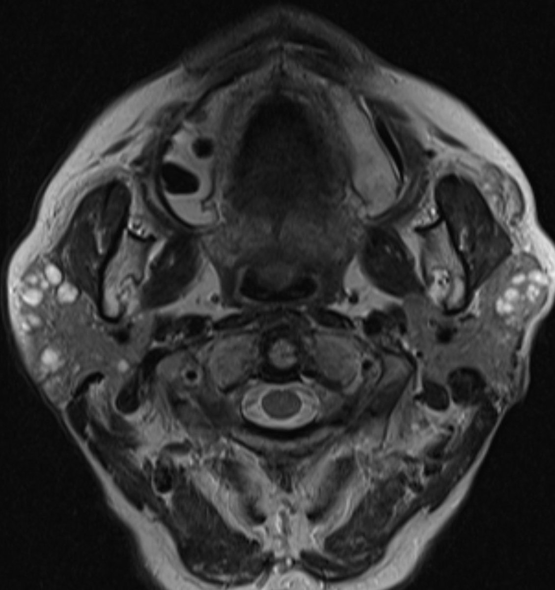 daniel_gewolb's tweet photo. βοΈ What is the most likely diagnosis in this 70 y/o F presenting for follow up cystic parotid lesions with history of Sjogren disease?
π·Second image was acquired 1 year later and the finding is new
#radres #radiology #futureradres #Medicine #ENT #neurology #neurosurgery #FOAMed #MRI @ASHNRSociety @TheASNR