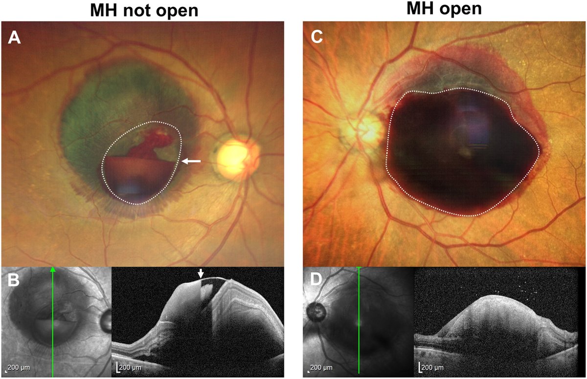AAOjournal's tweet photo. Niveau (level) as a key predictor for the absence of macular hole in sub-ILM hemorrhage secondary to retinal arterial macroaneurysm rupture
https://t.co/bbJ5wLMq8Z
#ophthalmology #retina https://t.co/3DwcRzdVeH