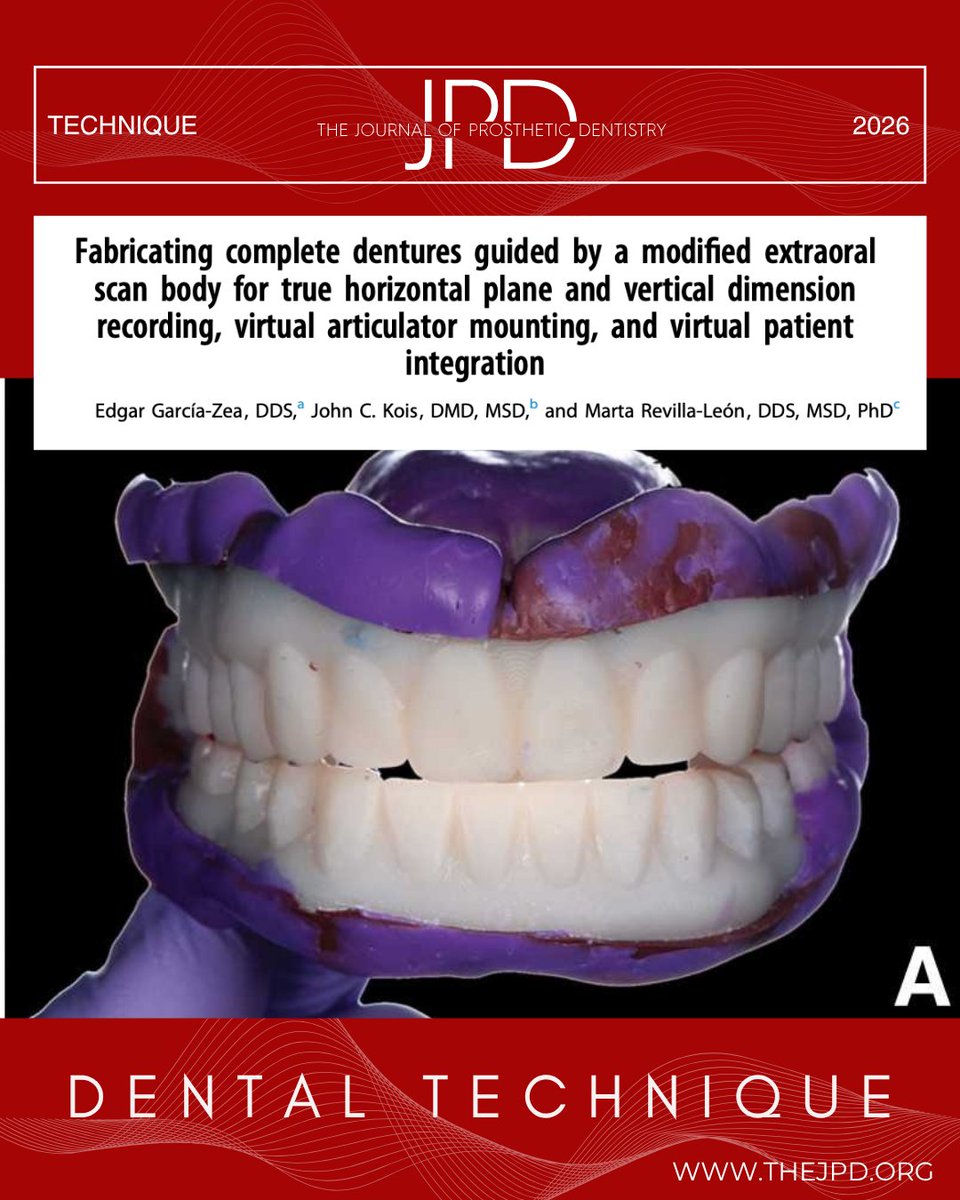 JPDentistry's tweet photo. #Digitaldentures are becoming more esthetically driven. This technique integrates natural head posture, true horizontal plane, vertical dimension, and virtual articulator mounting into a #digitalworkflow using a modified #extraoral #scanbody system. https://t.co/0I9pKdHR7G https://t.co/OQWzOHIVIu