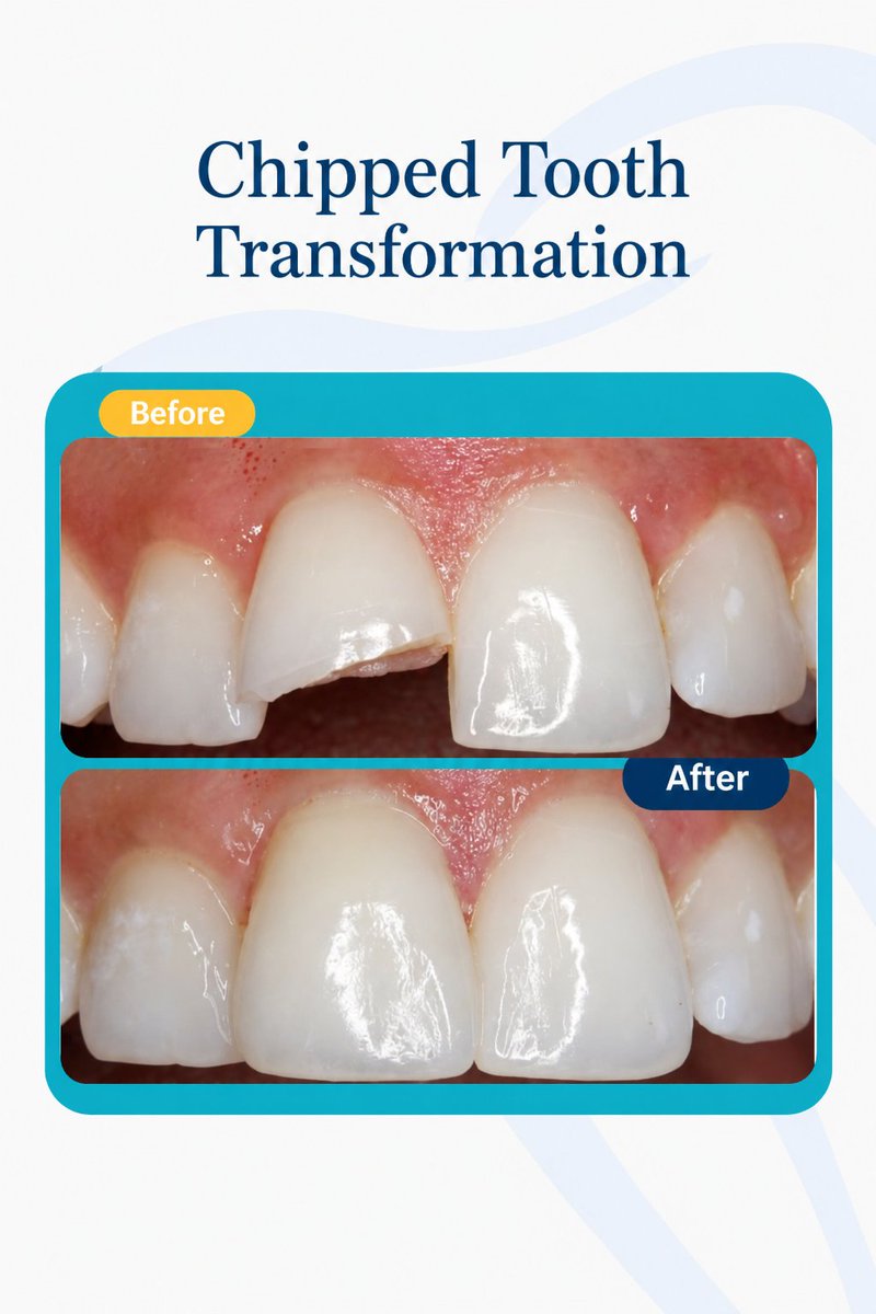 smilesdotcomng's tweet photo. A chipped tooth can change the way you smile, talk, and even feel about yourself.

Good thing it can be restored beautifully ✨

Simple, natural-looking results that bring confidence back. https://t.co/xC1fkZ1nCA
