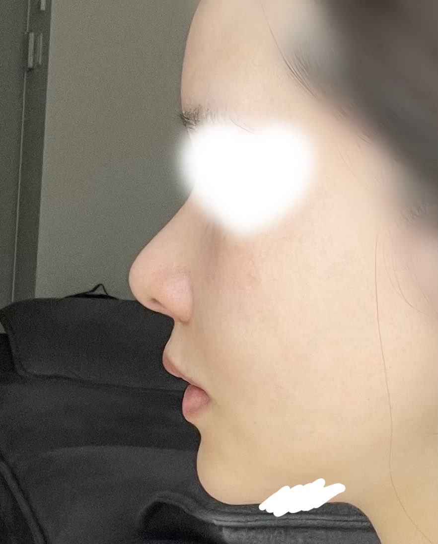 no_fabu's tweet photo. 鼻フル猫貴族ほんとうに神かもしれない❣️

✔中顔面の陥没
✔口ゴボ感
✔下顎の大きさ

全部解決してﾄﾞｰﾊﾟﾐﾝえぐい💧

まだ課題点いっぱいだけど中顔面の発達に感動🥺

before/after https://t.co/Nyv17ze1lh