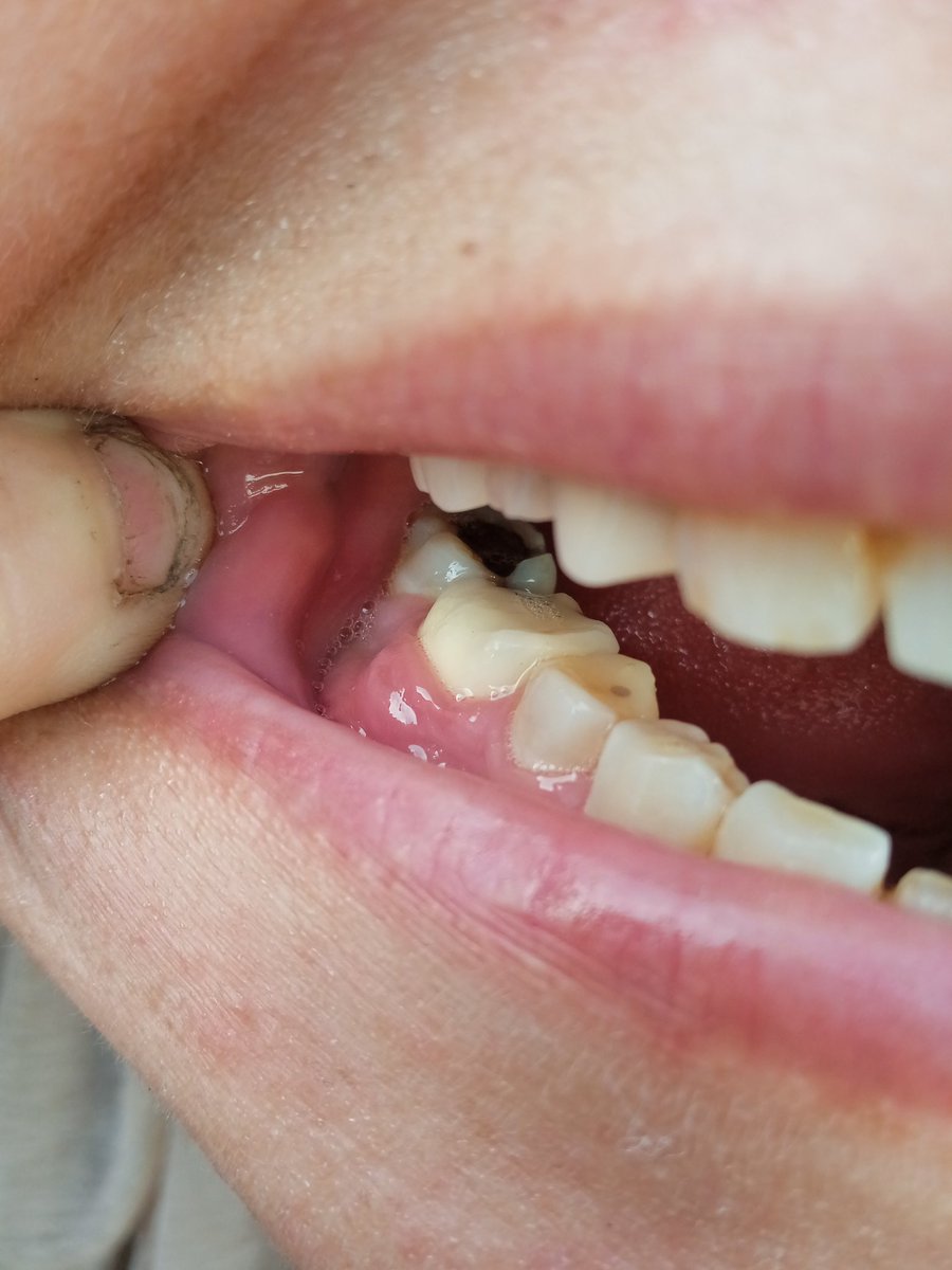 braa_akram14054's tweet photo. My mother is sick with her teeth today. She went to the doctor, and he told me she needs surgery on her jaw to remove a tumor. The surgery will cost $100, and I don't have that amount. The surgery will be done in four days. Please help my mother get the surgery immediately. https://t.co/ivQ9dkKKjD