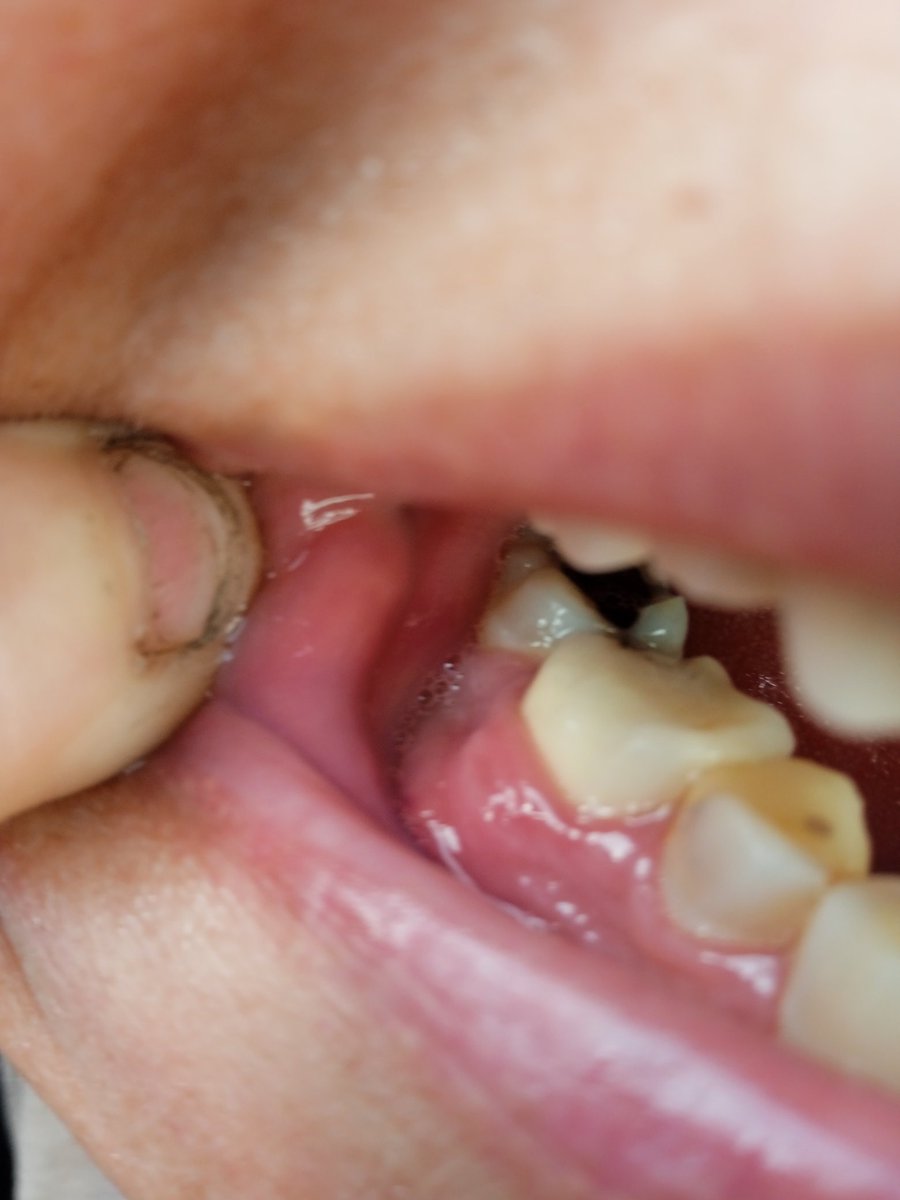 braa_akram14054's tweet photo. My mother is sick with her teeth today. She went to the doctor, and he told me she needs surgery on her jaw to remove a tumor. The surgery will cost $100, and I don't have that amount. The surgery will be done in four days. Please help my mother get the surgery immediately. https://t.co/ivQ9dkKKjD