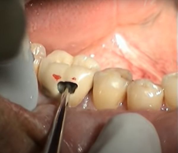 M_IDentistry's tweet photo. Great video by Goldent on the WAMkey gentle, time saving, cost saving crown and bridger remover available from us: https://t.co/461KnBBxPG
Watch Video: https://t.co/oXyiNem6RK https://t.co/1YpZRaPIz0