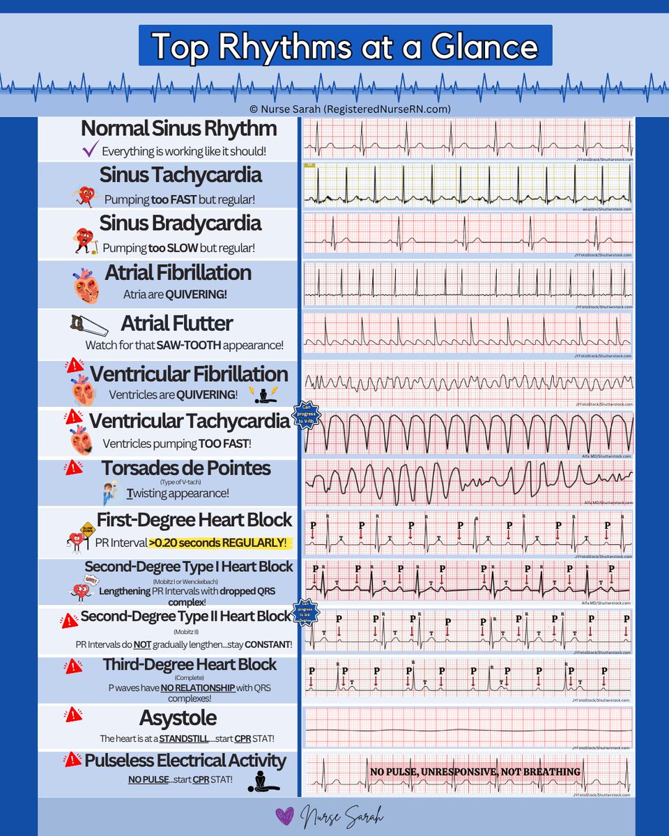 NursesRN's tweet photo. Top ECG rhythms you want to know:
Normal sinus rhythm = everything is working as it should
Sinus tachycardia = pumping too fast but regular
Sinus bradycardia = pumping too slow but regular
Atrial fibrillation = atria are quivering
Atrial flutter = saw tooth appearance
Ventricular fibrillation = ventricles are quivering
Ventricular tachycardia = ventricles are pumping too fast
Torsades de Pointes = twisting appearance
First-degree heart block = PR interval >0.20 seconds regularly
Second-degree heart block = Lengthening PR intervals with dropped QRS complex
Third-degree heart block  = P waves have no relationship with QRS complex
Asystole = heart is at a standstill. Start CPR STAT!
Pulseless electrical activity (PEA) = no pulse; start CPR STAT!