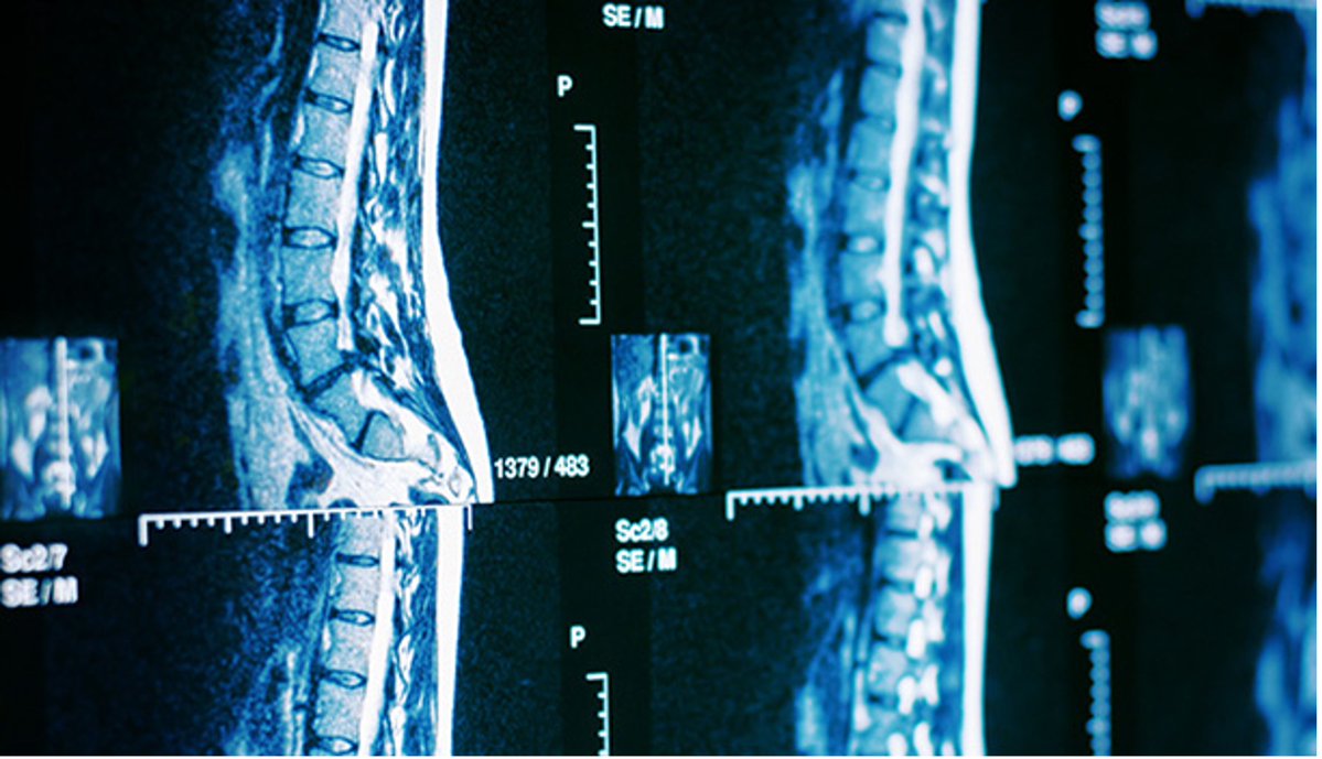HSSProfEd's tweet photo. ⏳The 2026 Frank P. Cammisa Jr., MD, HSS Spine Symposium is less than a month away!

#orthotwitter – Join us on June 12 to examine the current state and future trajectory of AI in spine care.

📍Onsite at @HSpecialSurgery (NYC) or virtual 

Enroll now: https://t.co/TUIWNWnVX5 https://t.co/Jodt8fnZ18