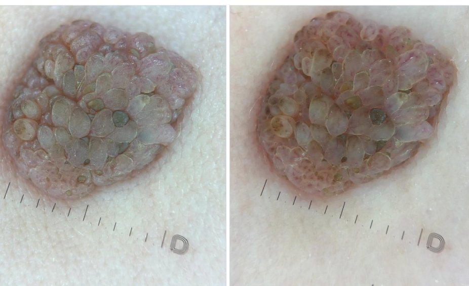 CemAy1623257's tweet photo. “A friend of mine sent this… After being with her boyfriend last night, she noticed something like this in her genital area. Has anyone experienced this before or knows what it could be?” 😳💭
#HPV #WomensHealth #SexualHealth #TwitterAsks https://t.co/M2ocb1M4Xt