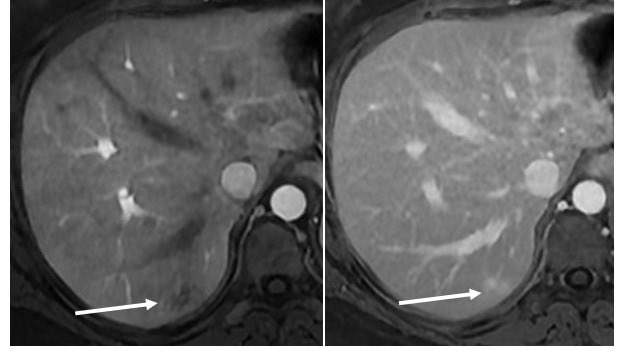 ElsayesKhaled's tweet photo. Answer is 
Focal Peliosis (potentially misinterpreted a met.). Key feature is following the blood pool enhancement (hemangioma would rather be more circumscribed). As shown in the images👇, there is a diffusion restriction.
Question: Can focal Peliosis restrict diffusion ? and why ? 

@ACOREdu @MedBlendPub 
 #MedicalEducation #Medblend #MedEd #radmeded #radiology #mentorship #coaching #residency #medstudent #IMG #meded #nrmp #MedTwitter #radresidents #radres #Match2026