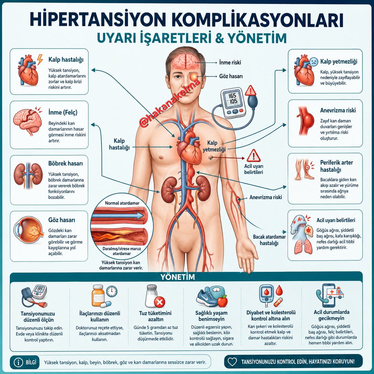 hakanakelma's tweet photo. ❤️HİPERTANSİYON yıllar içinde kalp, beyin, böbrek, göz ve damar sistemini yavaş yavaş bozan sistemik bir hastalıktır.

Tansiyon yükseldikçe damar duvarı sürekli mekanik strese maruz kalır. Bunun sonucu olarak;
 • Kalp krizi ve kalp yetmezliği
 • İnme (felç)
 • Böbrek yetmezliği
 • Retina hasarı ve görme kaybı
 • Anevrizma gelişimi
 • Periferik arter hastalığı riski belirgin artar.

Özellikle 180/120 mmHg üzerindeki değerler hipertansif kriz kabul edilir ve hedef organ hasarı açısından acil değerlendirme gerektirir.

Kan basıncı sınıflaması kabaca:

 🟢 Normal: <120 / <80
 🟡 Yüksek: 120–129 ve <80
 🟠 Evre 1 HT: 130–139 veya 80–89
 🔴 Evre 2 HT: ≥140 veya ≥90
 🚨 Hipertansif kriz: ≥180 ve/veya ≥120

📌Hipertansiyon tedavisinde yalnızca ilaç değil;
 ✔ Tuz kısıtlaması
 ✔ Kilo kontrolü
 ✔ Düzenli egzersiz
 ✔ Uyku kalitesinin düzeltilmesi
 ✔ Sigaranın bırakılması
 ✔ Diyabet ve lipid kontrolü
 en az ilaç kadar önemlidir.

‼️Unutmayın:‼️
 Tansiyon yükseldiğinde bazi zamanlar( özellikle belli bir basınca alışan kişilerde) belirti vermez. Bu yüzden birçok hastada ilk bulgu; inme, kalp krizi veya böbrek hasarı olabilir.

Tansiyon ölçmek basit bir işlemdir.  Tansiyon hastaları düzenli ölçerek kontrol etmeli.