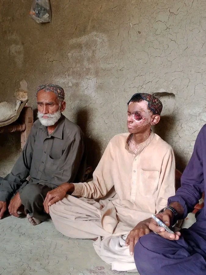 Baloch_tweets1's tweet photo. کینسر جیسی موذی مرض میں مبتلا اس بچے ہاشم بلوچ کا تعلق تمن کھوسہ کوہ سلیمان ضلع ڈیرہ غازی خان سے ہے۔
بدقسمتی سے اس علاقے سے اربوں روپے کے معدنی وسائل تو لوٹے جا رہے ہیں لیکن یہاں کے لوگوں کو بنیادی انسانی حقوق تک میسر نہیں اور بدلے میں کینسر اور دوسری موذی امراض تیزی سے بڑھ رہی ہیں۔
ریاست اس علاقے میں بڑھتے ہوئے کینسر اور دوسرے موذی امراض پہ خاموش تماشائی کا کردار ادا کر رہی ہے، امراض کی تشخیص، احتیاطی تدابیر اور تدارک کیلئے کوئی موثر اقدامات نہیں کیے گئے۔
کوہ سلیمان، تونسہ شریف اور  ڈیرہ غازی خان میں کینسر کے ہزاروں مریض جان سے چلے گئے اور ہزاروں مریض آج بھی علاج کے منتظر ہیں۔