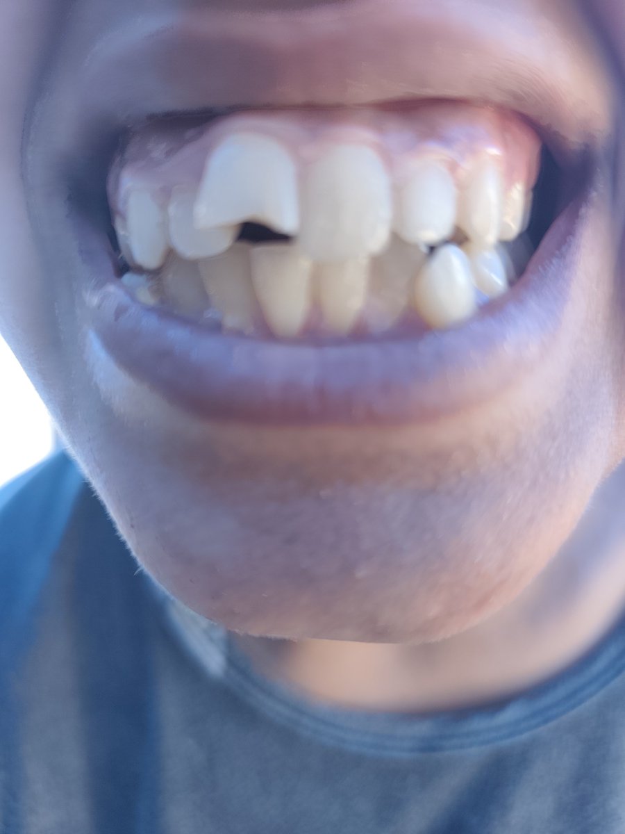 nozhanozha55434's tweet photo. My daughter's tooth pain is unbearable 💔
She desperately needs a root canal, but I can't afford it...
Please don't leave me alone, your support means so much to me 🙏

🚨 Please don't just pass by without doing something 🚨 Donate or share this post
https://t.co/UTGarzH8mG https://t.co/c5X18FbOeE