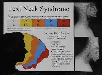 FryeChiro's tweet photo. Look down at your phone a lot?

For every inch your head moves forward, you neck and upper back take on more stress.

Over time: pain, stiffness, headaches, and poor posture can follow. 

#neckpain #posture #chiropractic https://t.co/g7mDuvZddM