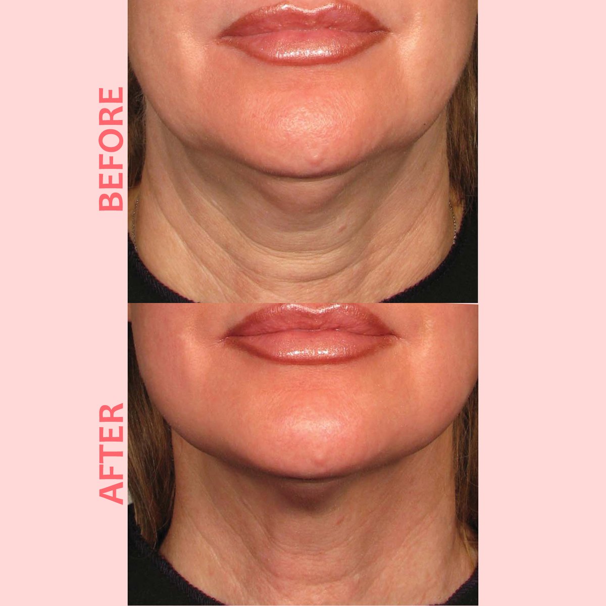 Amoderm's tweet photo. Ultherapy Special for Skin Tightening &amp; Collagen Stimulation - https://t.co/PgVGWweci3 https://t.co/6YNqdCkzdd